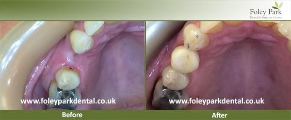 JW Dental Crowns Before And After 1