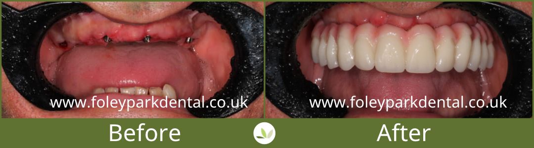 Dental implants before and after 13