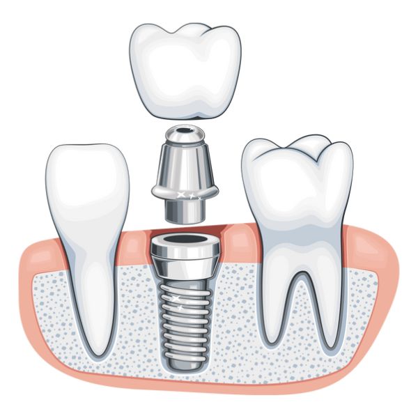 Dental implants or bridges