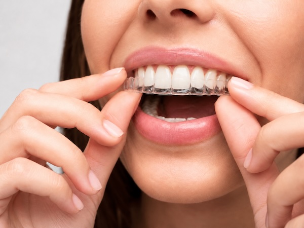 Why Dental Retainers Matter Long After Your Braces Come Off