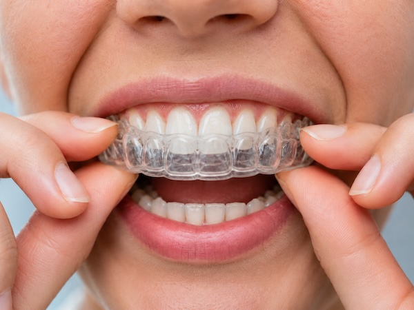 Do I Need a Night Guard for Teeth Clenching?